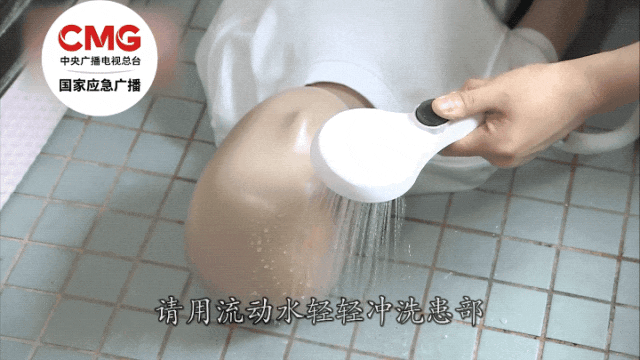 警惕 | 2岁幼童跌入高压锅，重度烧伤！家长这个做法严重错误......
